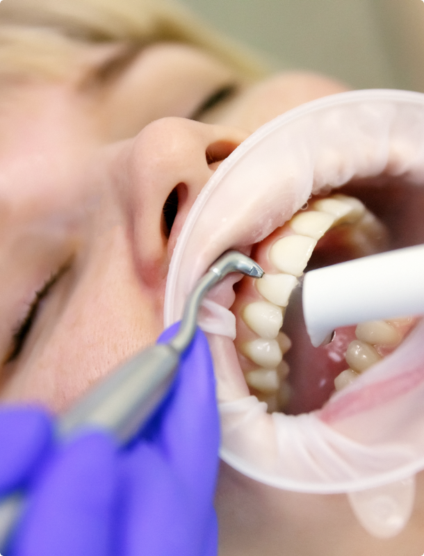 Профессиональная чистка зубов у стоматолога. Профгигиена (ультразвук + Air-Flow). Профгигиена полости рта Air Flow. Профгигиена зубов ультразвуком.